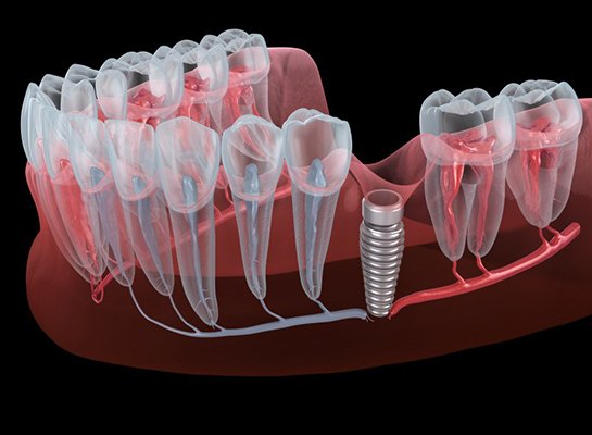Illustration of dental implant placed in gum tissue