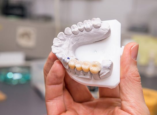 Hand holding sample teeth with bridge in place